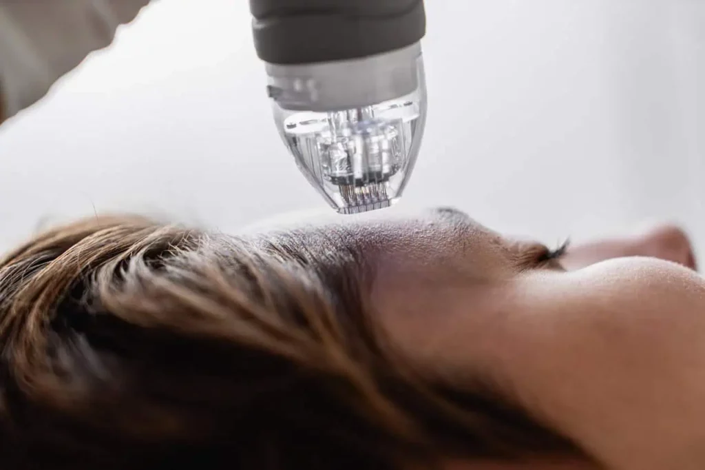 Microneedling at Warren OH | Youthology Med Spa