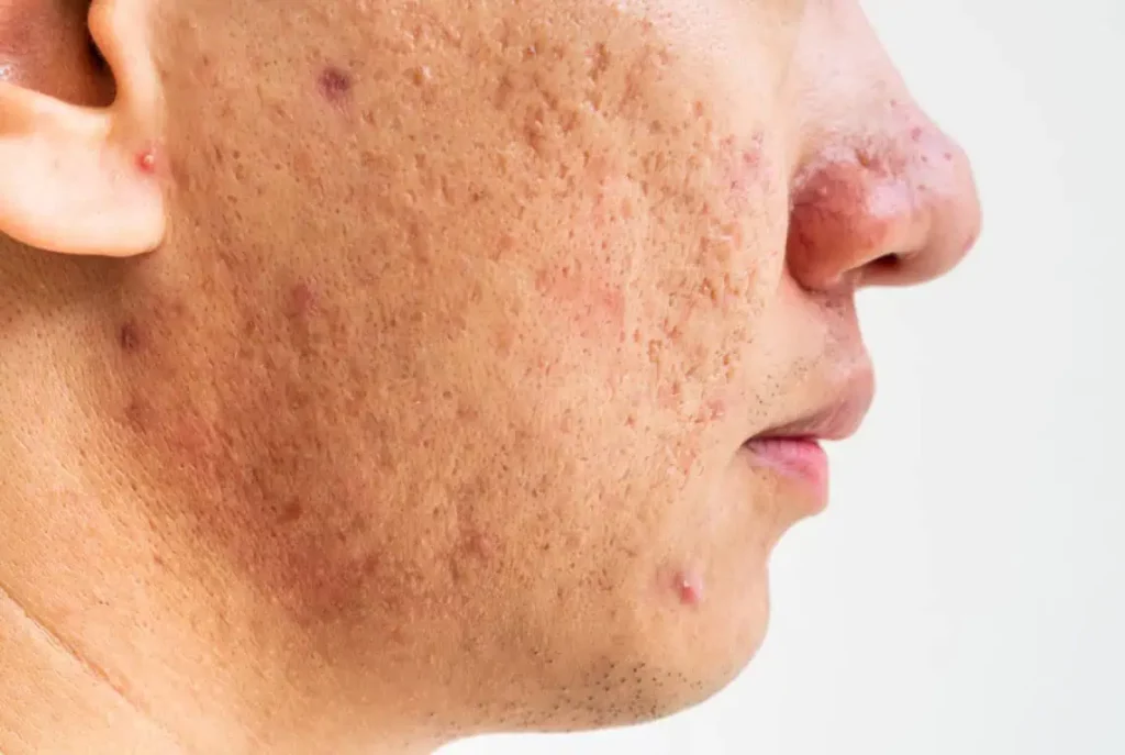 Scar and Vein Treatment in Warren OH | Youthology Med Spa