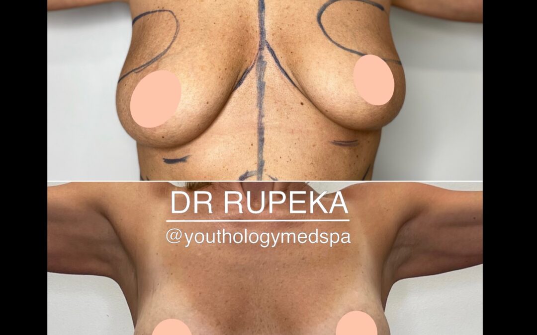 Breast Augmentation 2