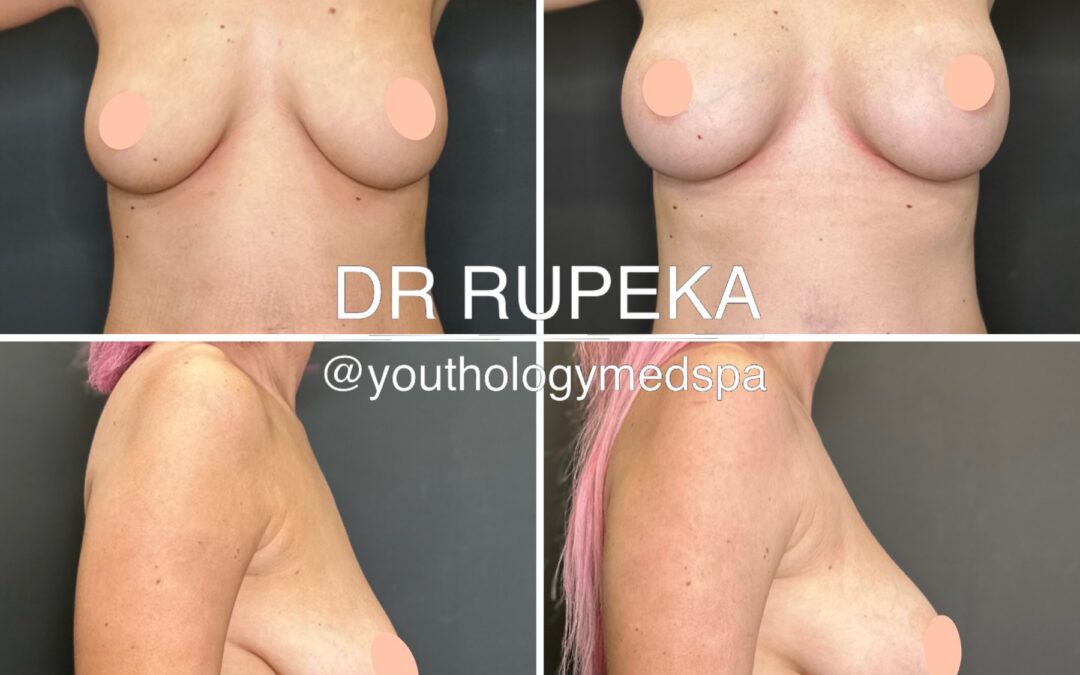 Breast Augmentation 3