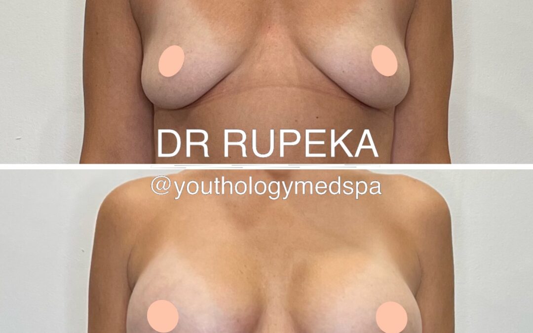 Breast Augmentation 5