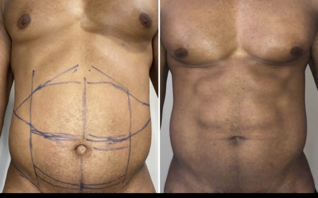 Liposuction 9