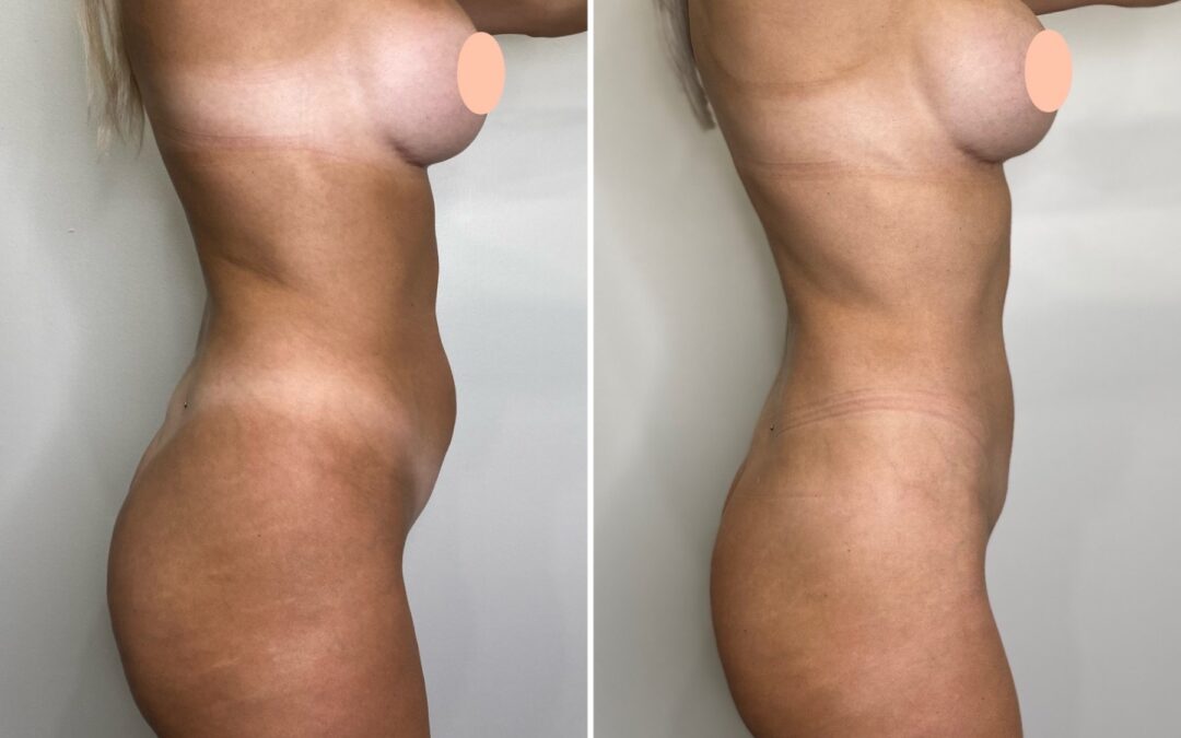 Liposuction 10