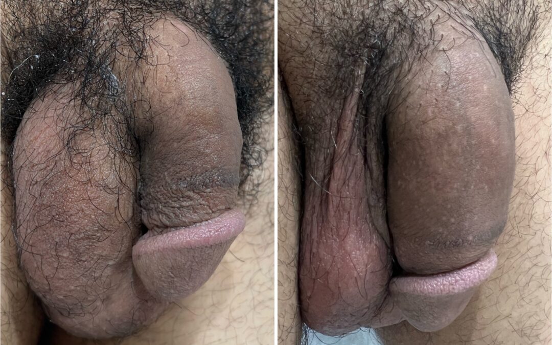 Penis Enhacement 2